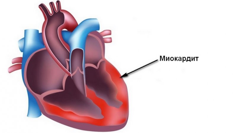 Миокардит